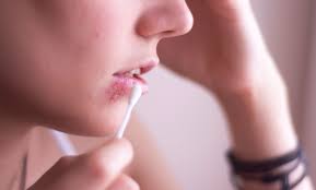 Zur zusätzlichen behandlung der erkrankung können sie pflanzliche salben mit melisseextrakt zum auftragen auf die lippen verwenden oder spezielle lippenpflaster einsetzen, die. Hausmittel Gegen Herpes Diese Helfen Am Besten