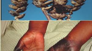 Image result for Ergotism