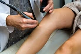This is why we chose the palomar vectus laser for permanent hair removal. Palomar And Candela Head To Court For Patent Case