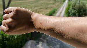Subscribe to ketv on youtube now for more. What To Do About Spider Bites Everyday Health