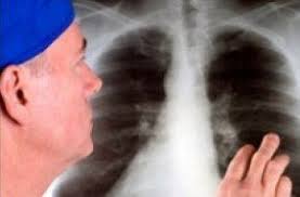 Check spelling or type a new query. Cancer Survivorship Versus Mesothelioma Deaths Mesotheliomahelp Org
