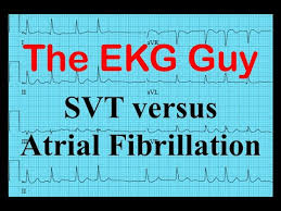 Stands for special vehicle team, from ford. Ekg Ecg Svt Vs Atrial Fibrillation The Ekg Guy Www Ekg Md Youtube