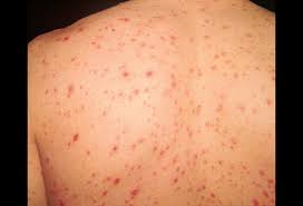 Pimples on buttocks will often appear as small raised bumps. Pictures Of Viral Skin Diseases And Problems Chickenpox Varicella Zoster Virus