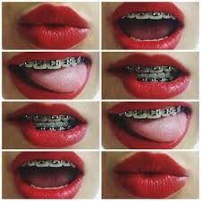 Black And Blue Braces Together Blog Not Found Braces Colors Braces Smile Cute Braces