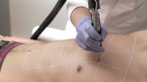 Elle se réalise à l'aide d'un laser qui émet une lumière monochromatique. L Epilation Laser Definitive Dos Et Epaules Chez L Homme