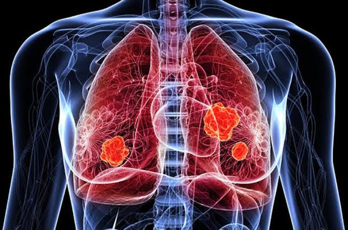 Cáncer de pulmón: Avances en Diagnóstico y Tratamiento en 2024