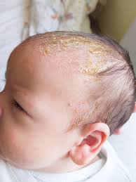 Image result for Cradle Cap