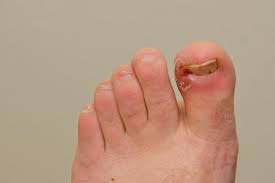 The numbness does not necessarily have to originating fr. Ingrown Toenail Treatment Causes And Symptoms