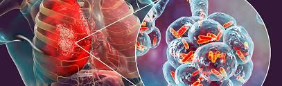 Sous le nom d'infection pulmonaire se cachent de nombreuses maladies telles que la bronchite, la bronchiolite, la pneumopathie ou la pneumonie. Pneumopathie Definition Et Symptomes Sante Sur Le Net