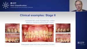 «the epidemiological evidence behind the association between periodontitis and incident atherosclerotic cardiovascular disease», клиническая периодонтология, 2013. Assessing Periodontitis Clinical Examples Key Points Tutorial By Mariano Sanz Youtube