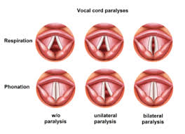 To hang a picture with disapproval, scorn, contempt, etc.; Vocal Cord Paresis Wikipedia