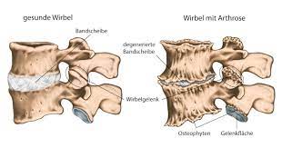 Maybe you would like to learn more about one of these? Spondylarthrose Facettensyndrom Stoppen Liebscher Bracht