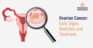 Ovarian cancer is a type of cancer that starts in a woman's ovaries. Ovarian Cancer Early Signs Detection And Treatment