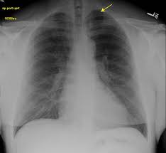 Consult a doctor for medical advice. Dry Needling Induced Pneumothorax
