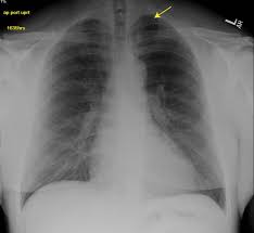 Pneumothorax is defined as air that has entered the pleural space, either spontaneously or as a result of traumatic tears in the pleura after chest injury or . Dry Needling Induced Pneumothorax