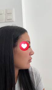 The day my casket came off VS my nose 3 months after. I was so sad when my  casket came off, dissapointment struck immediately but i'm so happy now.  For all the