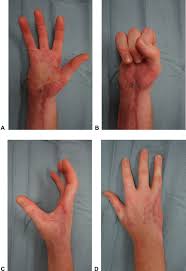 Image result for phlegmon of hand)