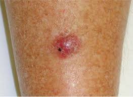 More than half of merkel cell carcinomas (mccs) occur in the head and neck of elderly people, in areas of actinically damaged skin. Cancers Free Full Text Merkel Cell Polyomavirus Molecular Insights Into The Most Recently Discovered Human Tumour Virus Html