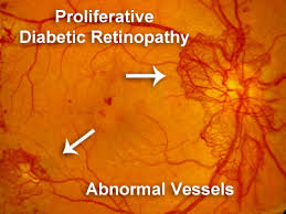 Find national data on vision and eye health. Proliferative Diabetic Retinopathy