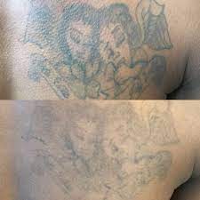 Tattoo removal is typically considered a cosmetic procedure and cosmetic procedures are not covered by insurance companies because they are not medically necessary. Tattoo Removal On Black Asian Skin Lorena Oberg