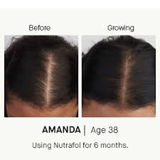 It is commonly stated that hair grows about 1cm per month on average; Amazon Com Nutrafol Women S Balance Hair Growth For Thicker Stronger Hair Peri And Postmenopause 4 Capsules Per Day 1 Month Supply Beauty