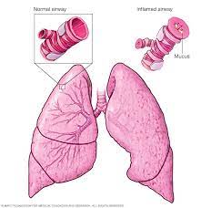 Take off the mouthpiece cover, then: Asthma Symptoms And Causes Mayo Clinic