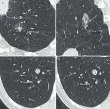 Lung Nodules Size Still Matters European Respiratory Society