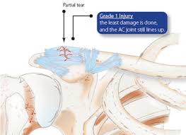 Brighton and sussex university trust started its physiotherapy led virtual fracture clinic in september 2013. Shoulder Separation Ac Joint Separation Causes Symptoms Treatment Braces