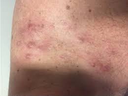 Bronystories 2,192 followers · 200 following. Posters 2017 Australasian Journal Of Dermatology Wiley Online Library