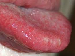What To Do About Tongue Blisters Dental News Pakistan