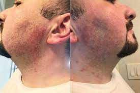 Why You Get Razor Burns And How To Prevent It – Men's Soap Company