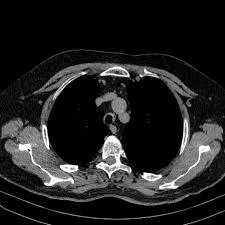 Image result for Relapsing Polychondritis