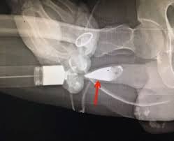 Image result for Retrograde Urethrogram