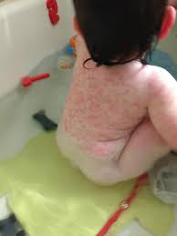 For most adults, the benefits of the mmr vaccine outweigh the risks. An Unexpected Side Effect Of My Daughter S Measles Vaccine Kveller