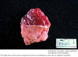 Image result for Myopathy