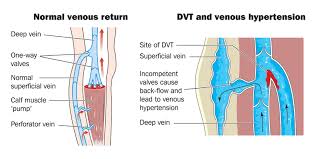 A number of treatment regimens are now available for acute dvt. What Is Deep Vein Thrombosis And What Are The Treatments