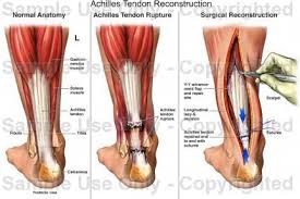 Related online courses on physioplus. Achilles Tendon Ruptured Achilles Tendon Ruptures Achilles Tendonitis Achilles