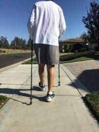 What is the recovery time after knee replacement? Walking Two Weeks After Knee Replacement Photos