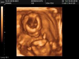Publié pararlette lecomte modifié depuis plus de 6 années. Echographie 3d Proche Longwy Metz Nancy Aout 2018 Babycenter