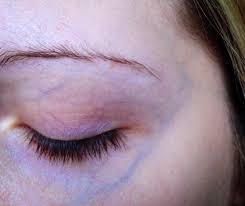 Knowing what is causing your red veins in the eyes is the beginning of striking the best way of getting rid of the condition. Dr Rachel Ho Veins Around The Eyes