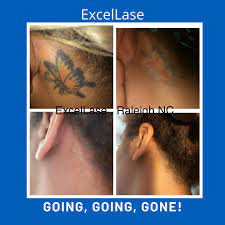 We can also remove tattoo. Nc Tattoo Removal Posts Facebook