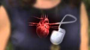 Welcome to icd and pacemaker support. Defibrillator Pacemaker What S The Difference Youtube