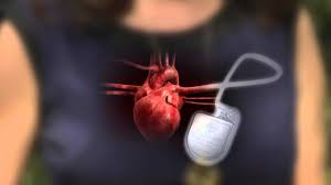 Does it give you shocks? Defibrillator Pacemaker What S The Difference Youtube