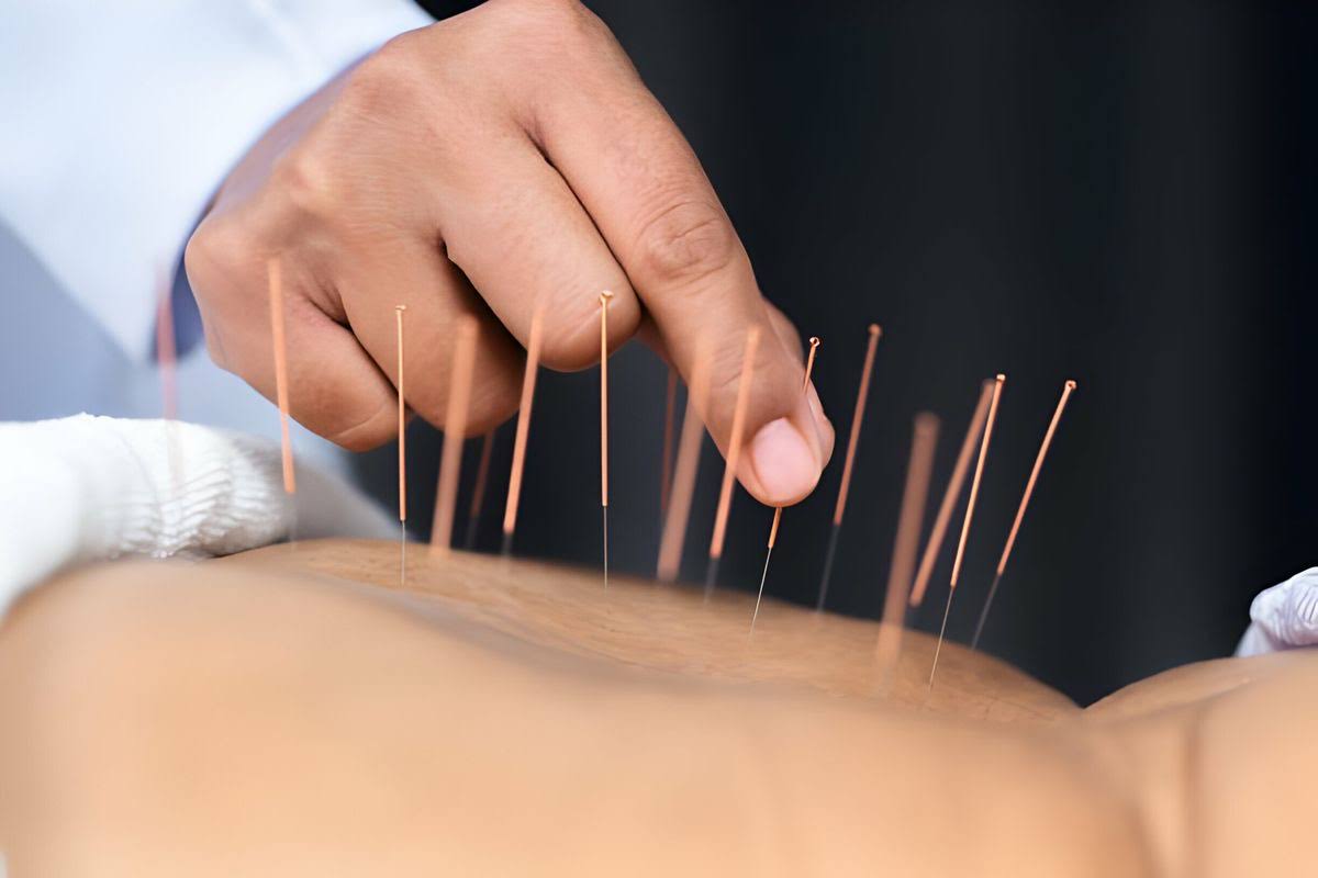 Dry Needling product image