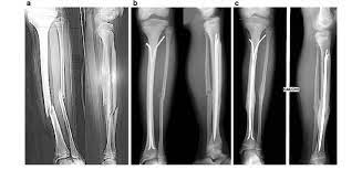 Tell your healthcare provider about all the medicines you take, including. Tibia Fracture Treated By Esin A Displaced Shaft Fracture Of Fibula Download Scientific Diagram