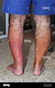 Image result for erysipel photos)