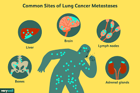 Whether the cancer has spread to nearby tissues, into the lymph nodes or to other places in the body, which is called metastasis. Common Sites Of Lung Cancer Metastases