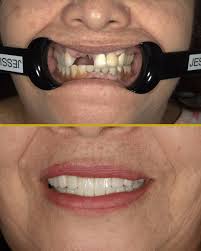 Behind every before and after is a story of courage. They walked in with  fear. They walked out with pride. This is what happens when care meets  compassion. 🦷💙 Book your consultation,