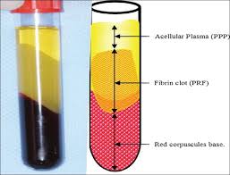Augenringe, halonierte augen, halonierung der periorbitalen region oder med. Prf Zentrifuge Plattchenreiches Fibrin Zentrifuge Blut Prf Fur Detistry Kiefer Chirurgie Orthopadie Kunststoff Chirurgie Centrifuge Prf Aliexpress
