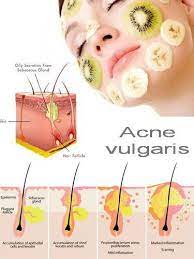 Contro cellulite, acne giovanile e brufoli, è fondamentale mantenere l' intestino pulito già a partire dalla mattina: Acne Cibi In Out Malattie E Disturbi Della Pelle Forumsalute It